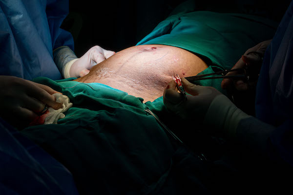 U.S. Air Force OBGYNs perform a laparoscopic bilateral salpingectomy during RS24